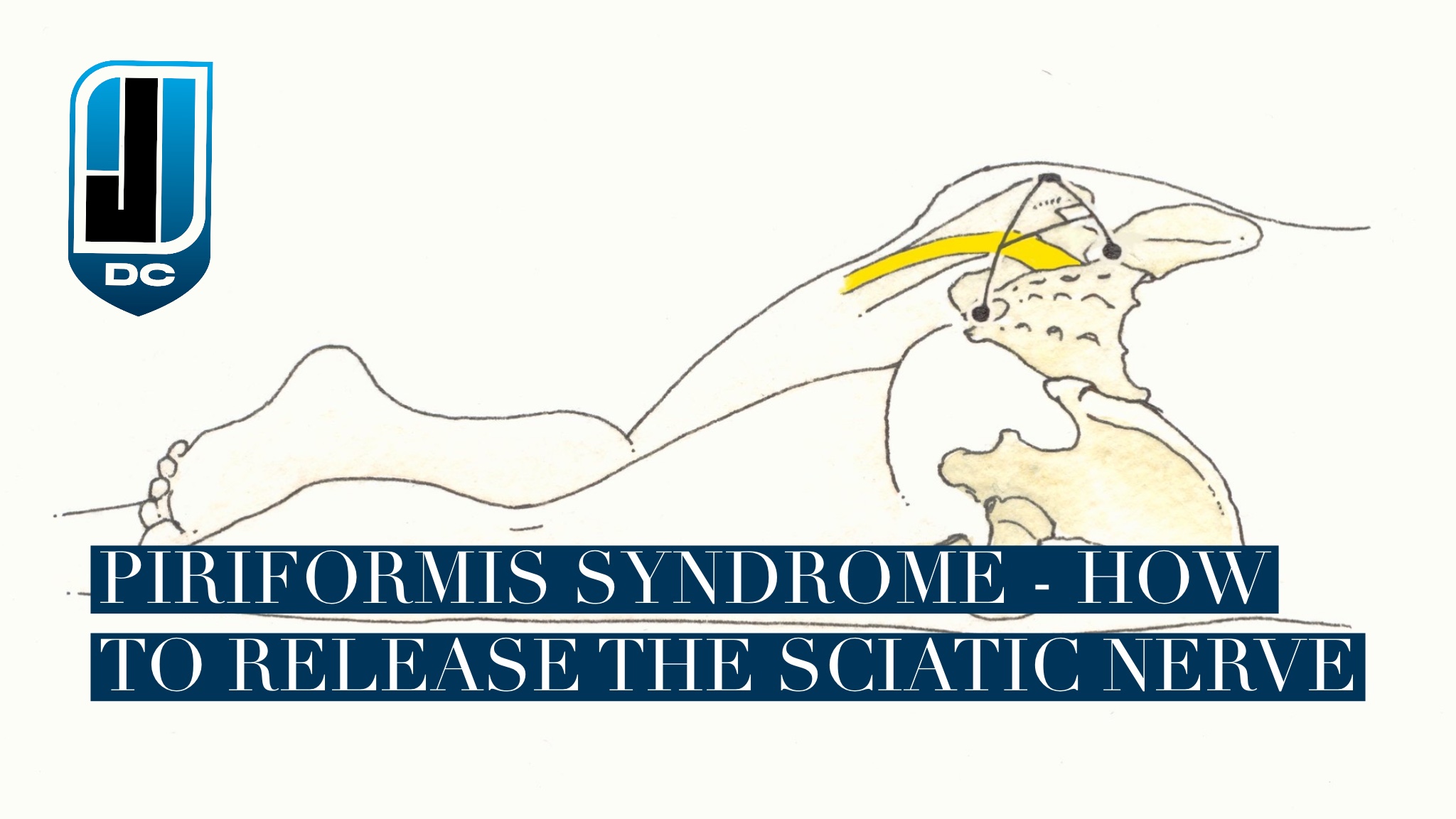 How to release the sciatic nerve in piriformis syndrome